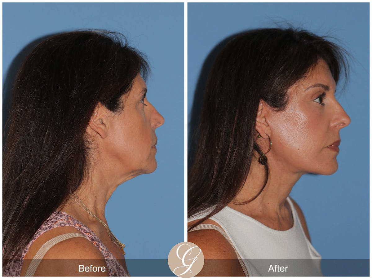 Preservation Facelift Before & After Gallery - Patient 128927 - Image 3