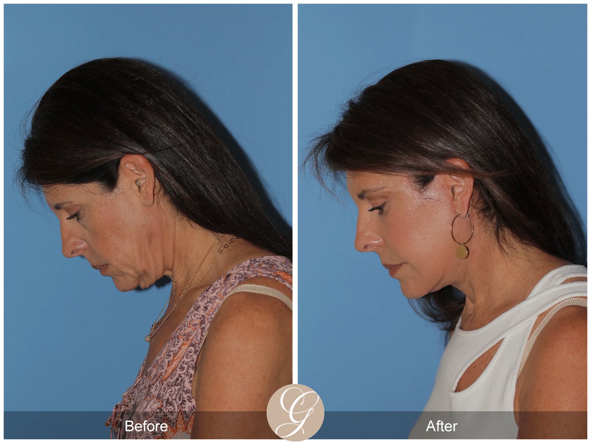 Preservation Facelift Before & After Gallery - Patient 128927 - Image 9