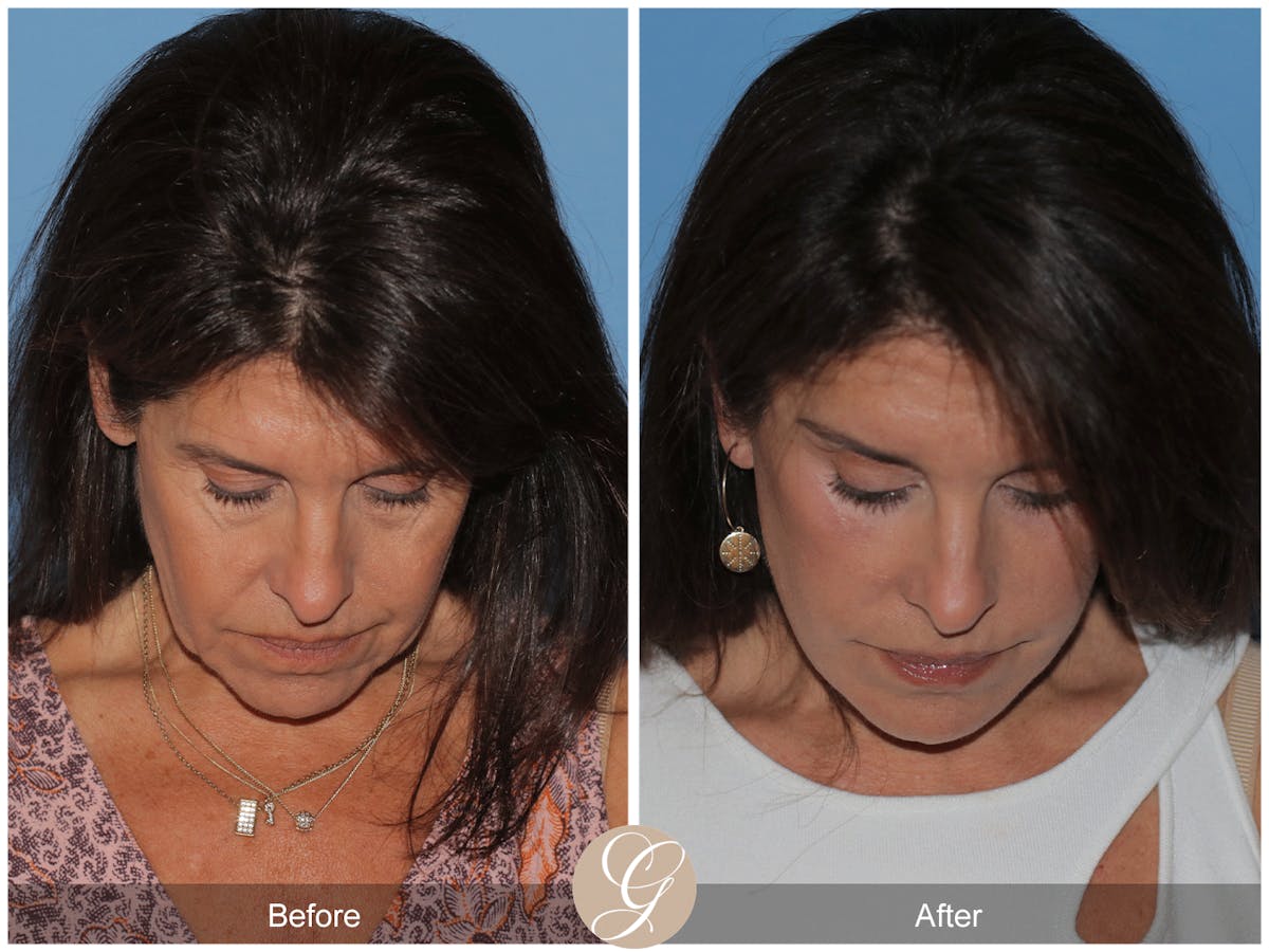Preservation Facelift Before & After Gallery - Patient 128927 - Image 12