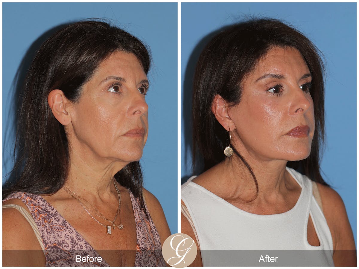 Preservation Facelift Before & After Gallery - Patient 128927 - Image 7