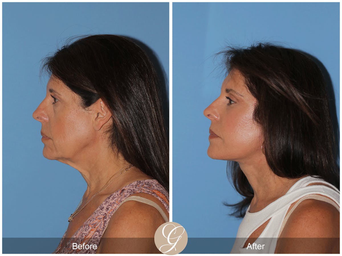 Preservation Facelift Before & After Gallery - Patient 128927 - Image 5