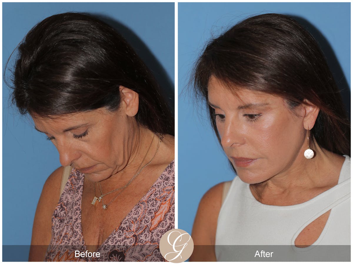 Preservation Facelift Before & After Gallery - Patient 128927 - Image 10