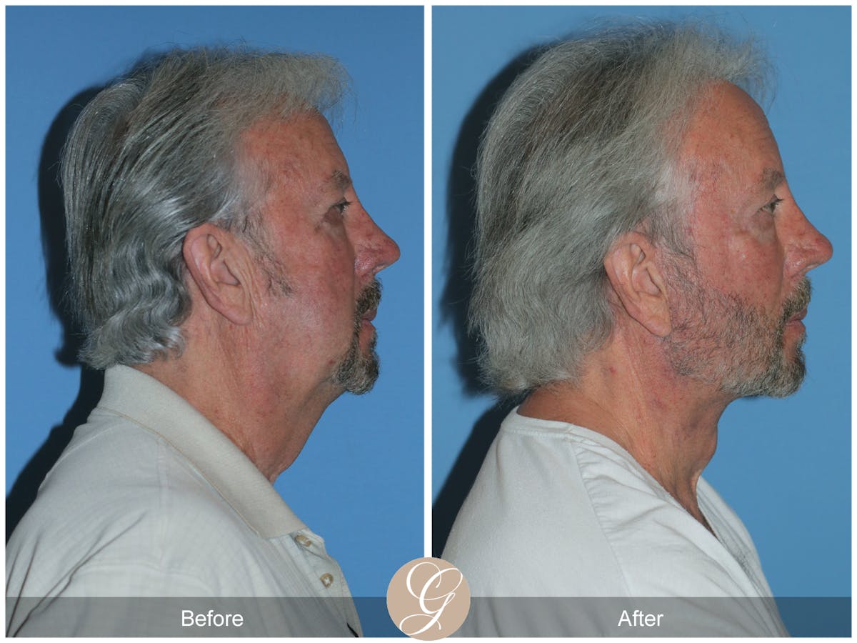 Facelift Male Before & After Gallery - Patient 392231 - Image 8
