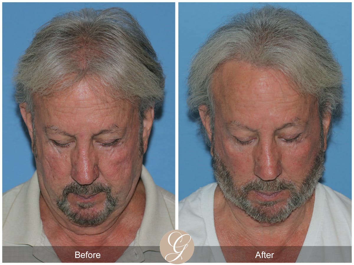 Facelift Male Before & After Gallery - Patient 392231 - Image 5