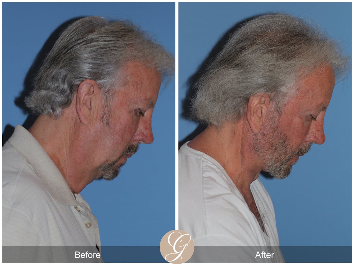 Facelift Male Before & After Gallery - Patient 392231 - Image 7
