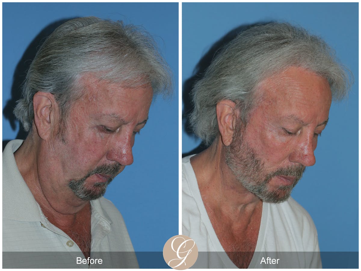 Facelift Male Before & After Gallery - Patient 392231 - Image 9