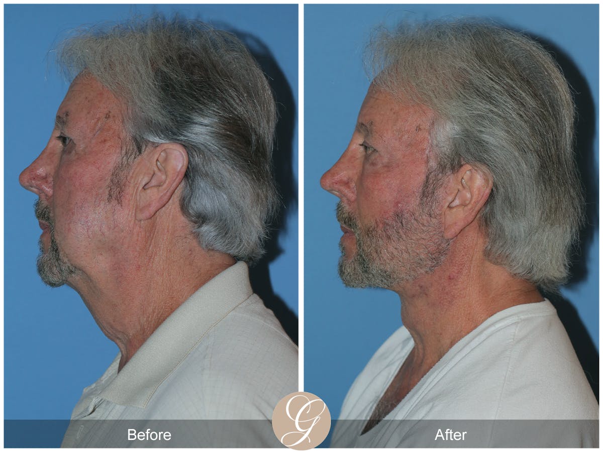 Facelift Male Before & After Gallery - Patient 392231 - Image 10