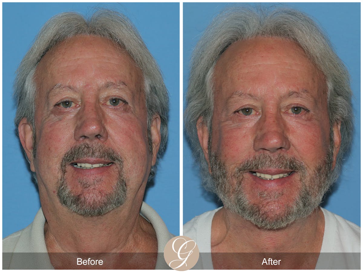 Facelift Male Before & After Gallery - Patient 392231 - Image 2