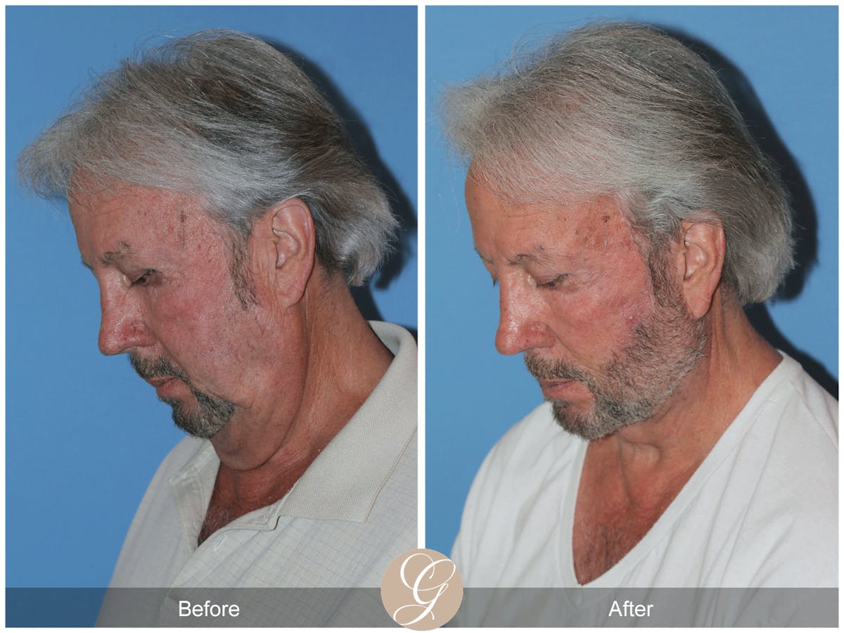 Facelift Male Before & After Gallery - Patient 392231 - Image 4