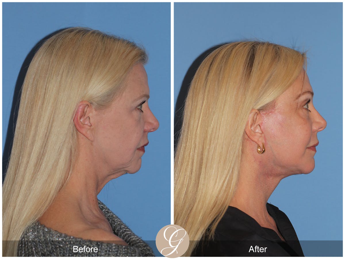 Preservation Facelift Before & After Gallery - Patient 108078 - Image 7