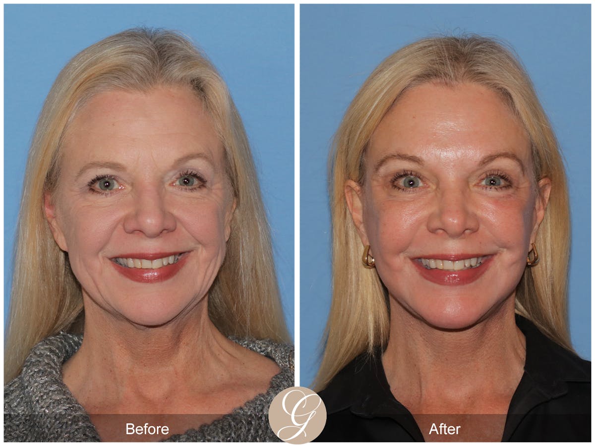 Preservation Facelift Before & After Gallery - Patient 108078 - Image 1