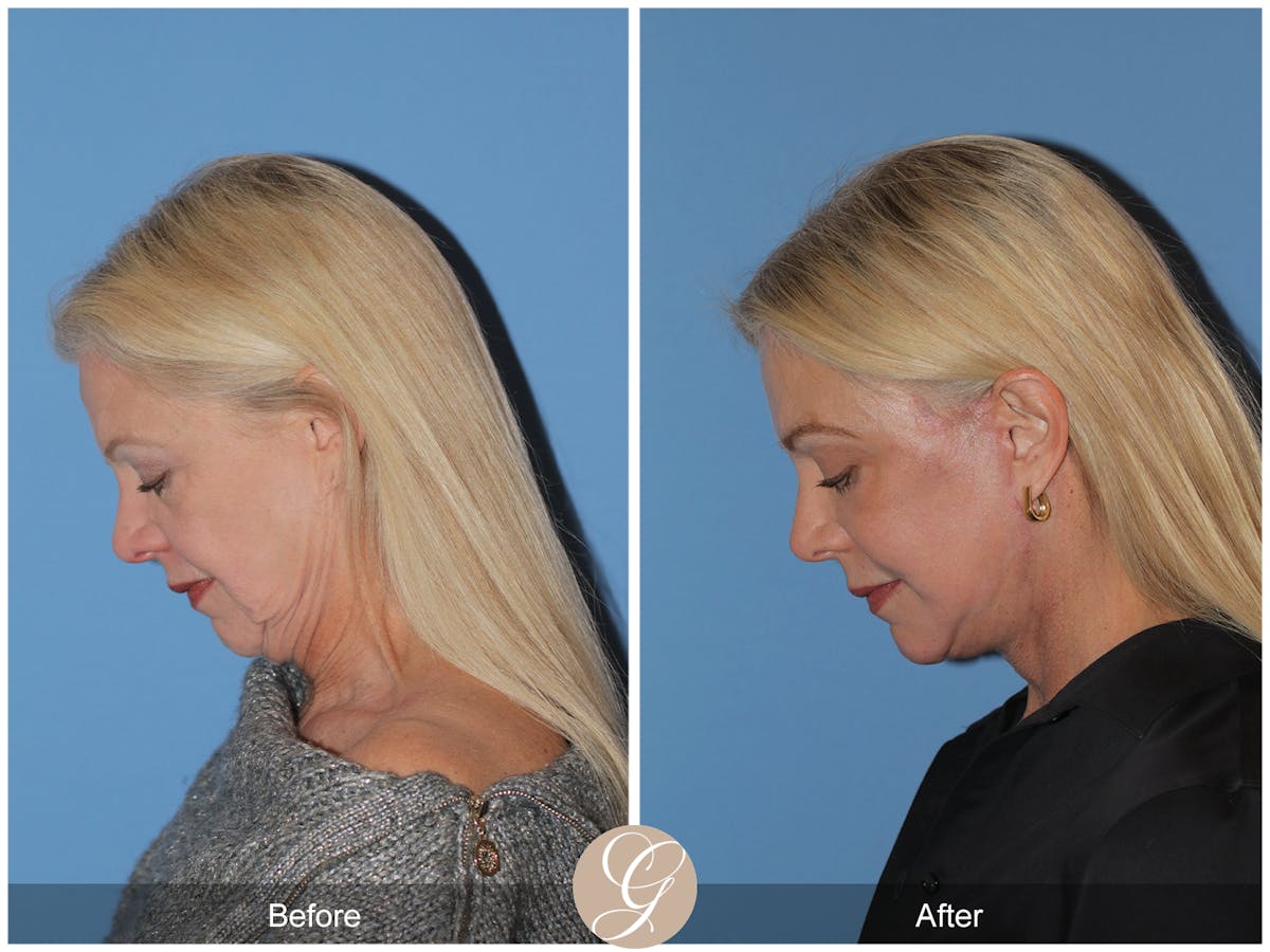 Preservation Facelift Before & After Gallery - Patient 108078 - Image 3