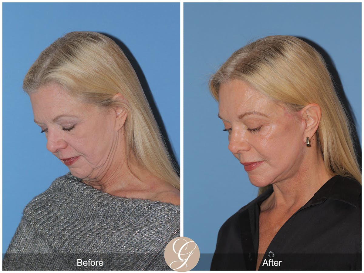 Preservation Facelift Before & After Gallery - Patient 108078 - Image 8