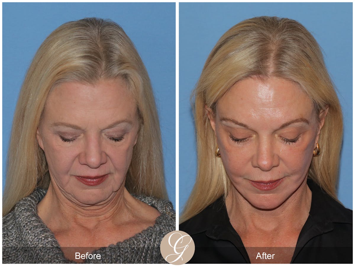 Preservation Facelift Before & After Gallery - Patient 108078 - Image 9