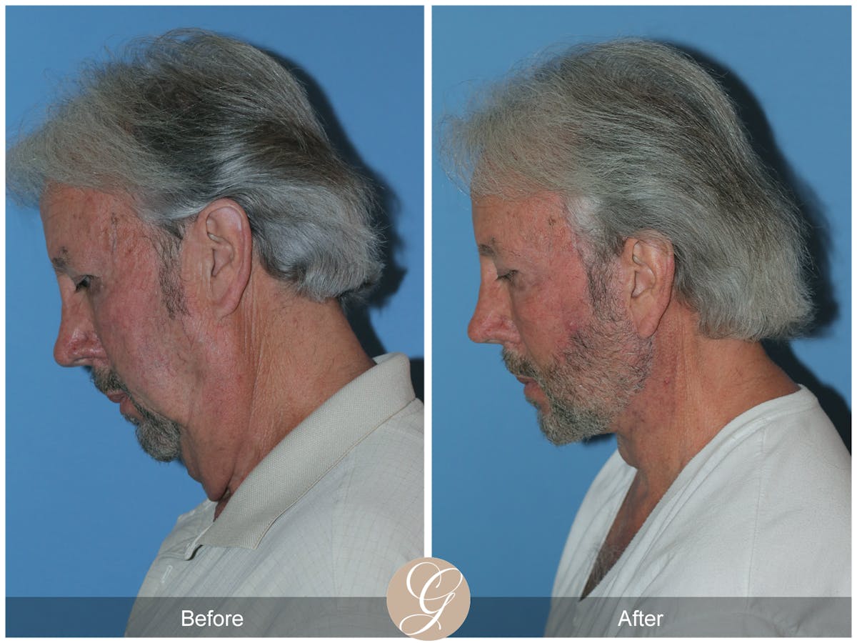 Facelift Male Before & After Gallery - Patient 392231 - Image 11