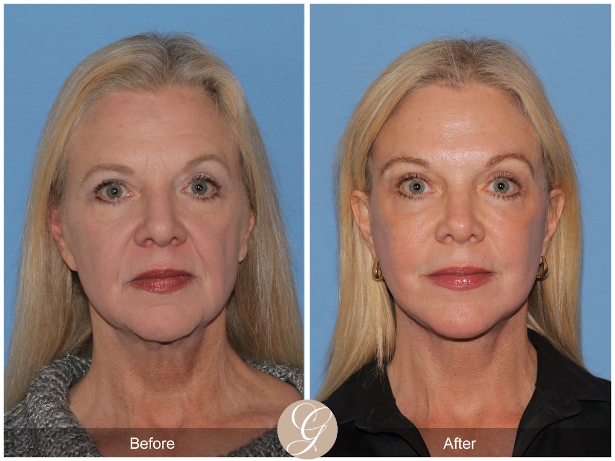 Preservation Facelift Before & After Gallery - Patient 108078 - Image 6