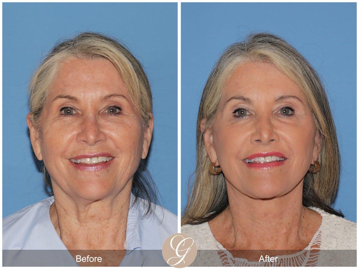 Preservation Facelift Before & After Gallery - Patient 829855 - Image 1