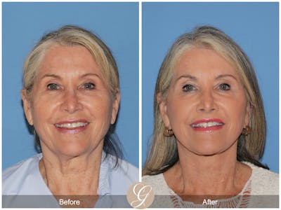 Deep Plane Facelift Before & After Gallery - Patient 357533 - Image 1