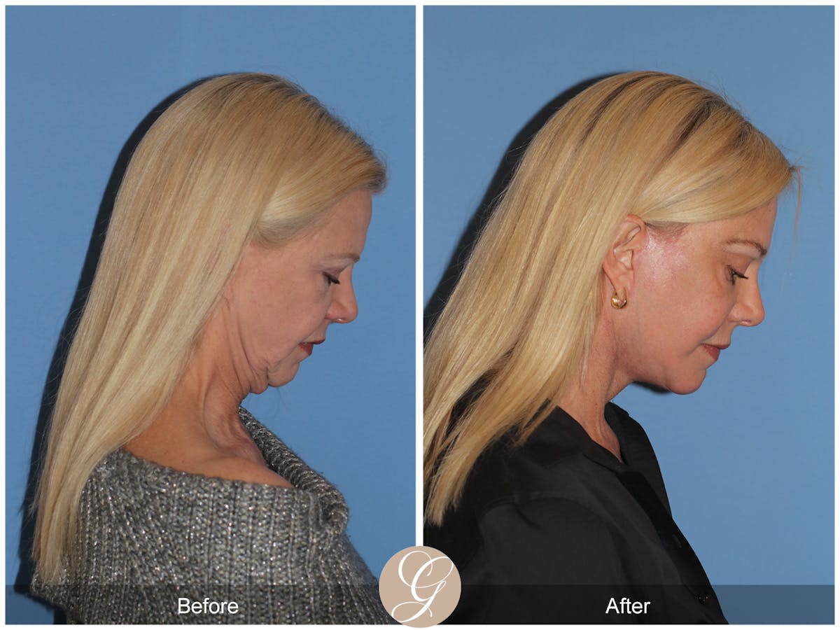 Preservation Facelift Before & After Gallery - Patient 108078 - Image 11