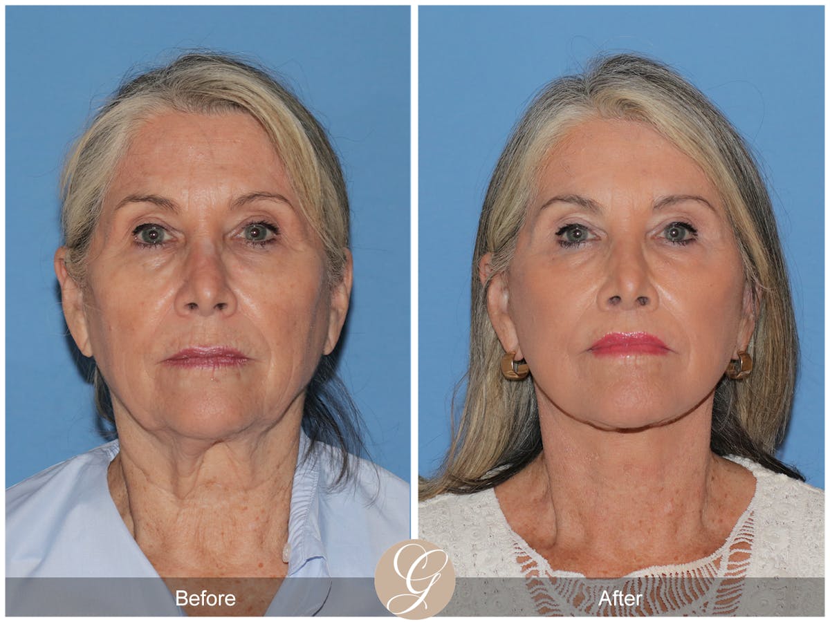 Preservation Facelift Before & After Gallery - Patient 829855 - Image 6