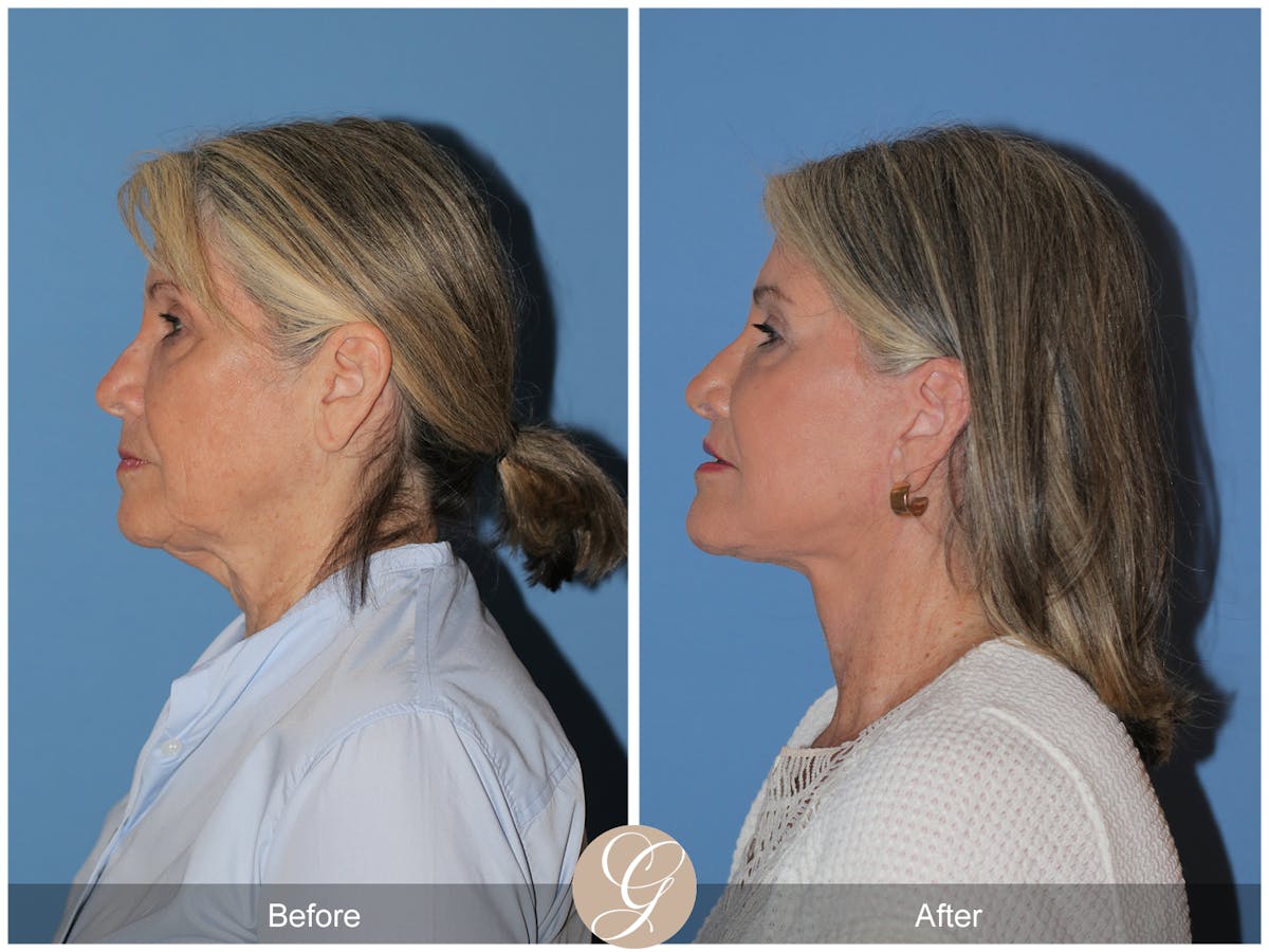 Preservation Facelift Before & After Gallery - Patient 829855 - Image 4