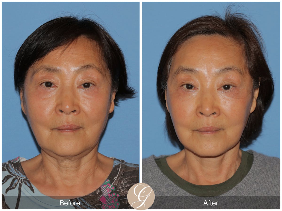 Deep Plane Facelift Before & After Gallery - Patient 142649 - Image 1