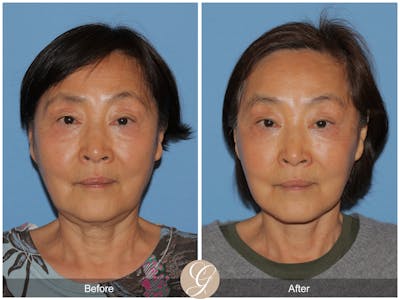 Deep Plane Facelift Before & After Gallery - Patient 142649 - Image 1