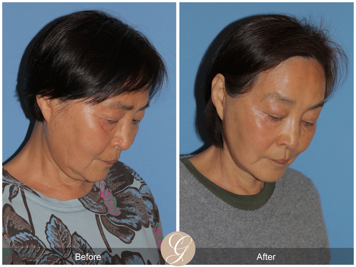Deep Plane Facelift Before & After Gallery - Patient 142649 - Image 4