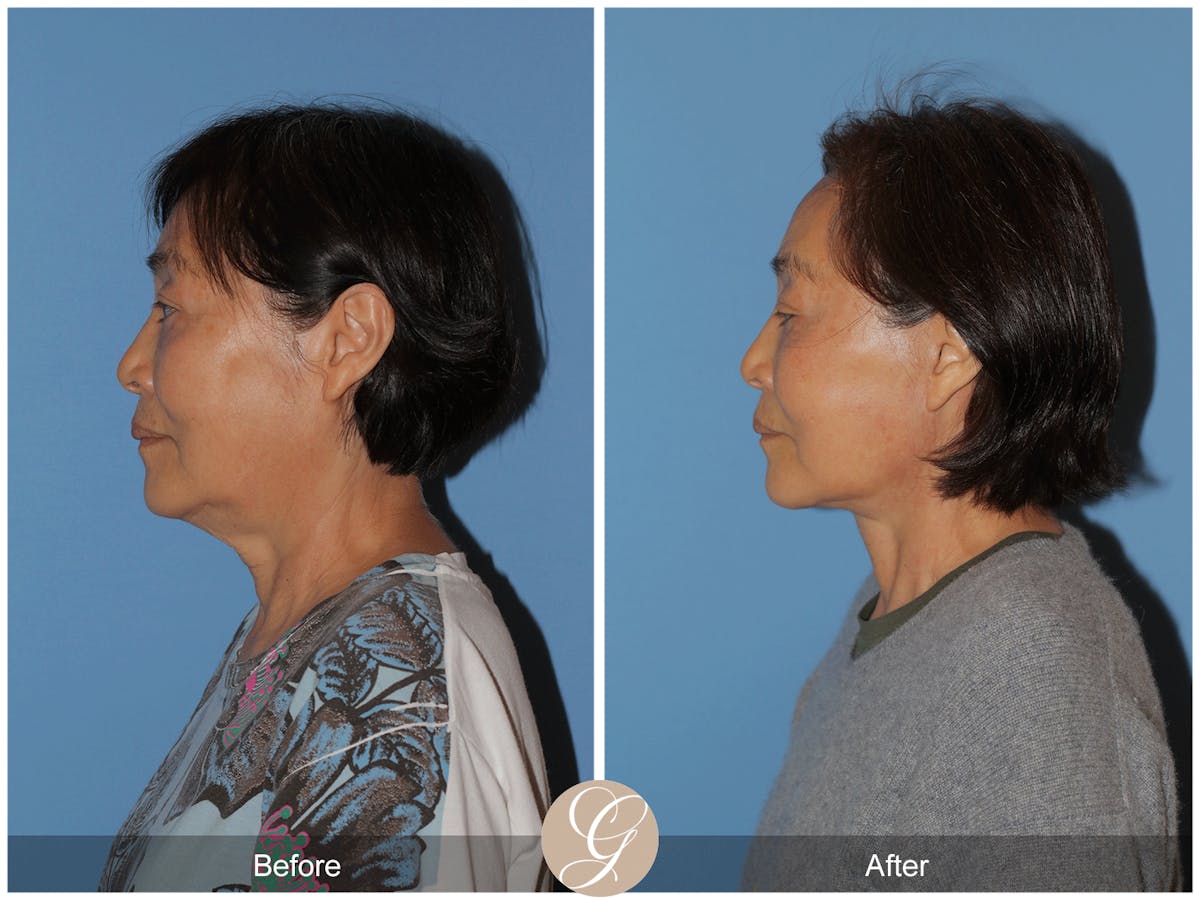 Deep Plane Facelift Before & After Gallery - Patient 142649 - Image 7