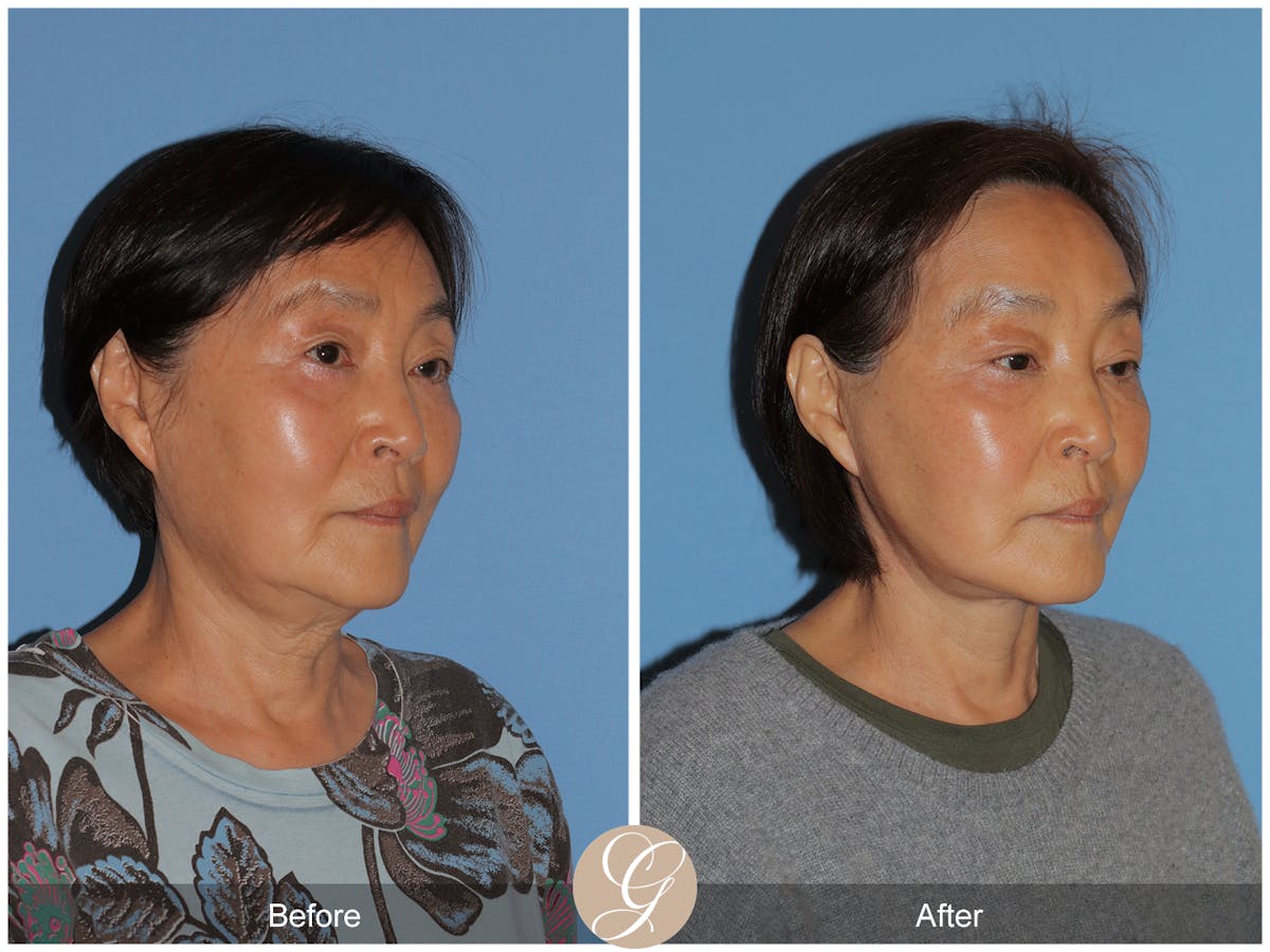 Deep Plane Facelift Before & After Gallery - Patient 142649 - Image 5