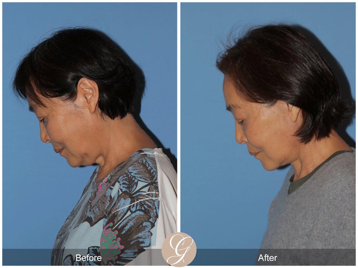 Deep Plane Facelift Before & After Gallery - Patient 142649 - Image 8