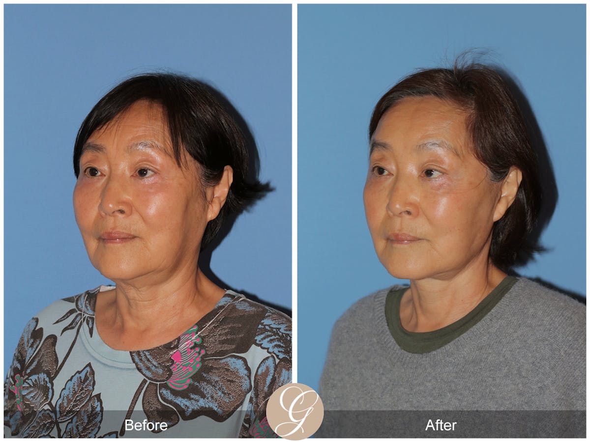 Deep Plane Facelift Before & After Gallery - Patient 142649 - Image 9