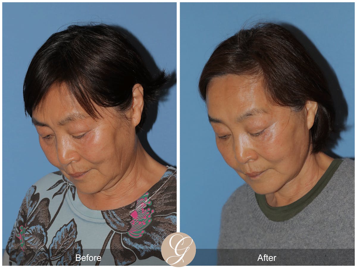 Deep Plane Facelift Before & After Gallery - Patient 142649 - Image 2