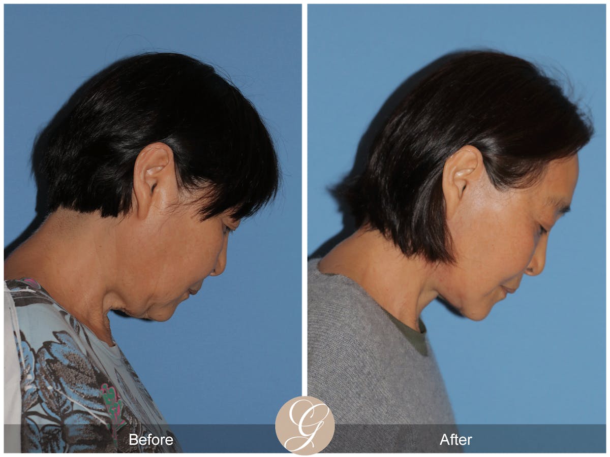 Deep Plane Facelift Before & After Gallery - Patient 142649 - Image 6