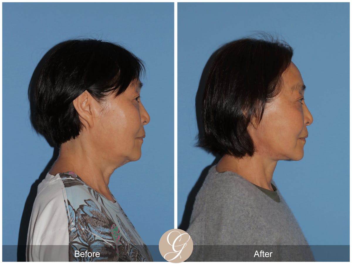 Deep Plane Facelift Before & After Gallery - Patient 142649 - Image 3