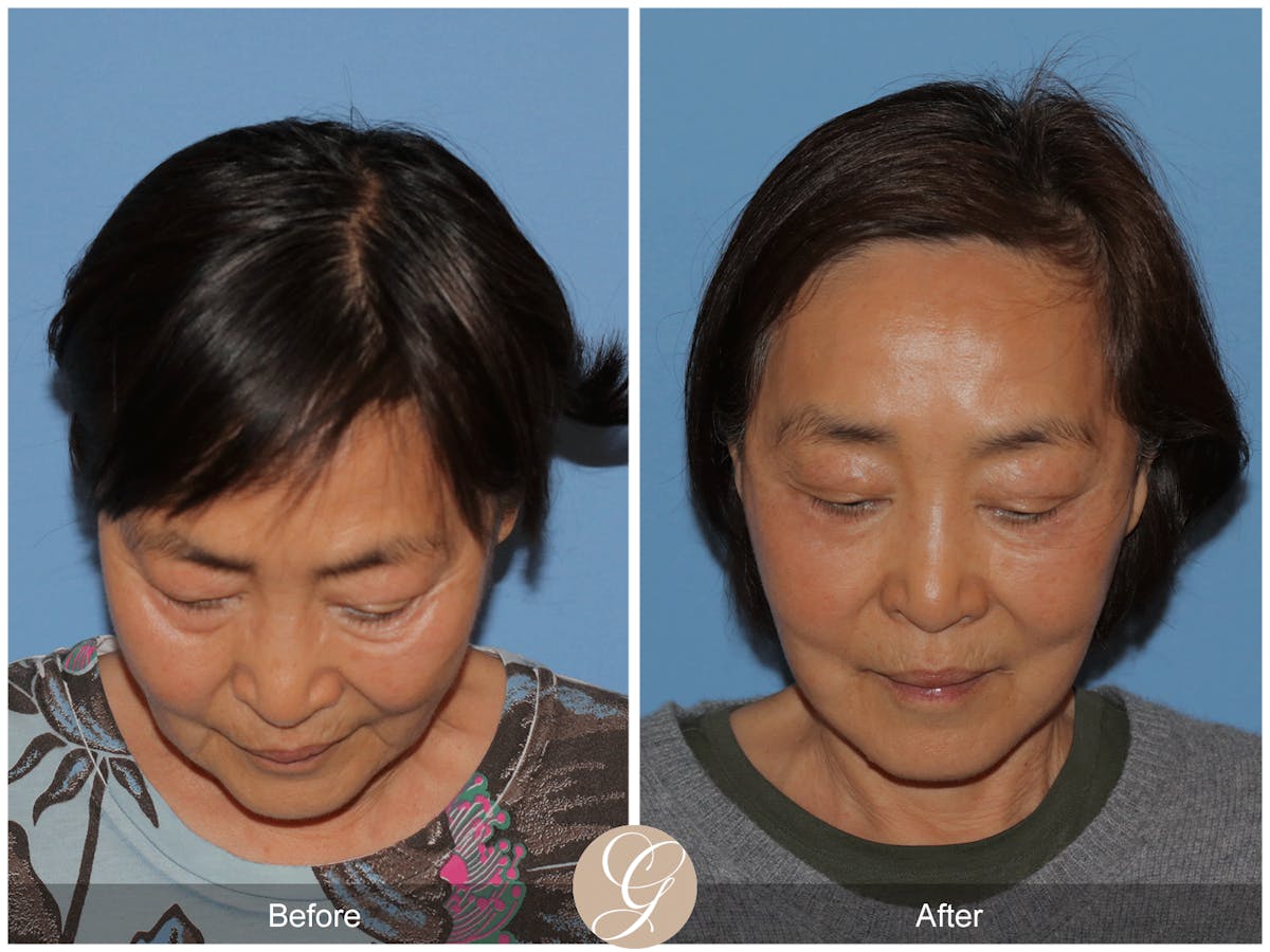 Deep Plane Facelift Before & After Gallery - Patient 142649 - Image 10