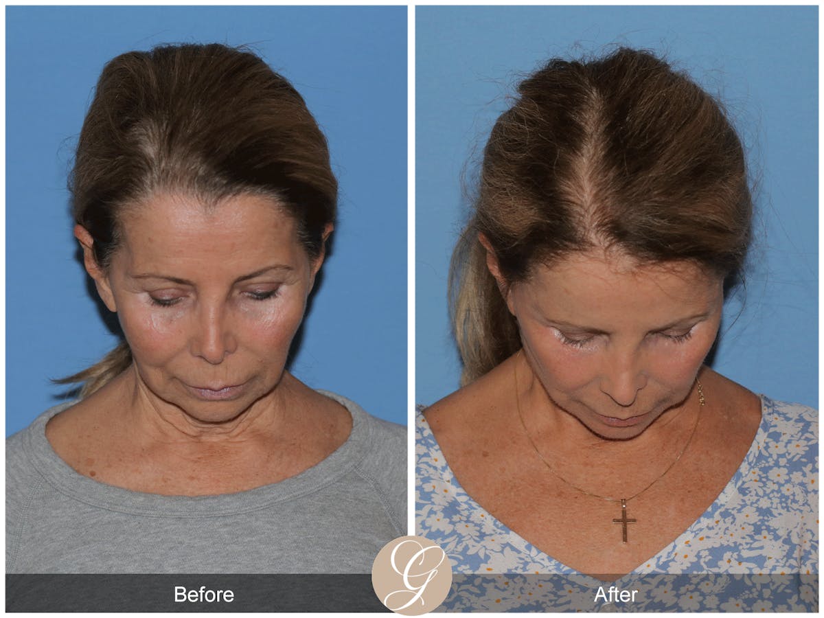 Preservation Facelift Before & After Gallery - Patient 101043 - Image 3