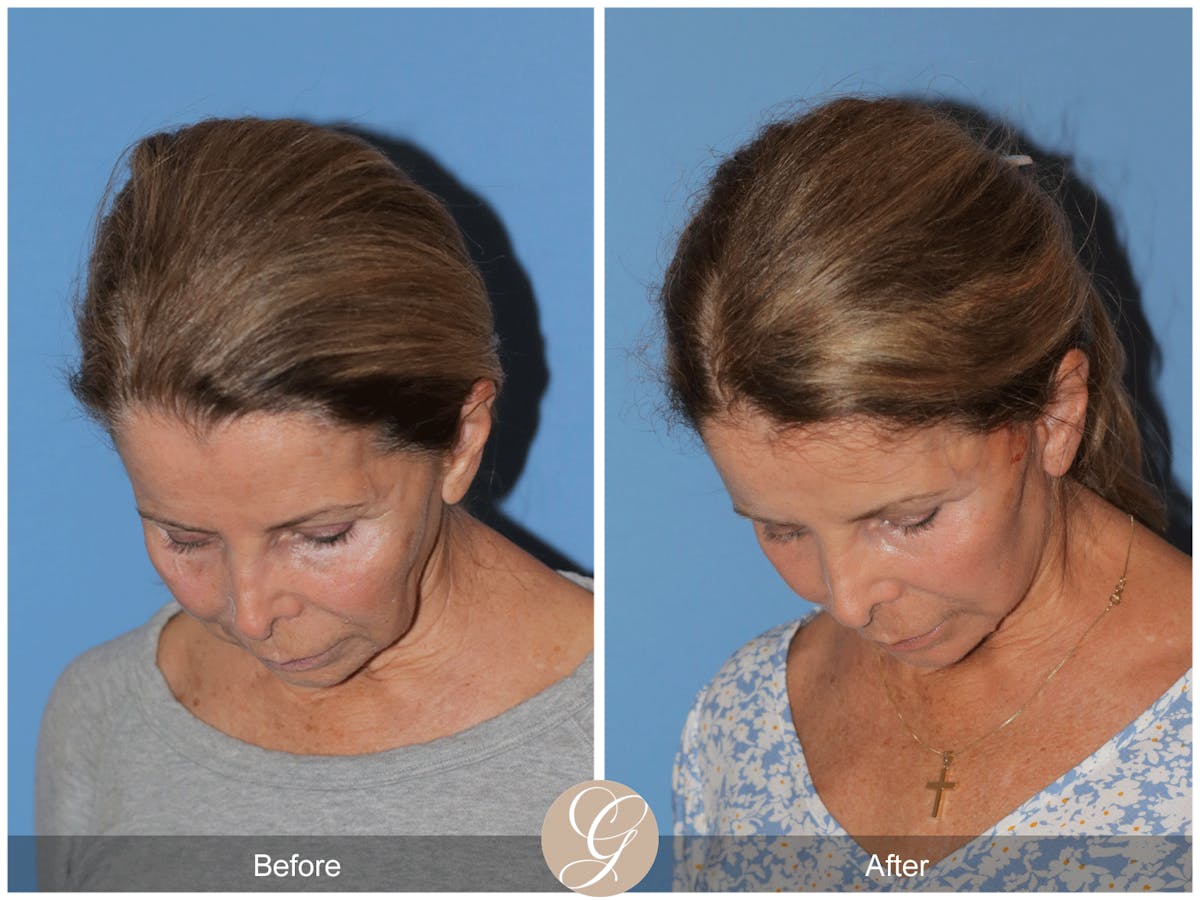 Preservation Facelift Before & After Gallery - Patient 101043 - Image 2