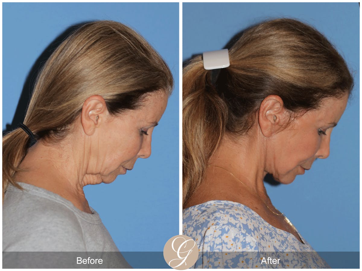 Preservation Facelift Before & After Gallery - Patient 101043 - Image 5