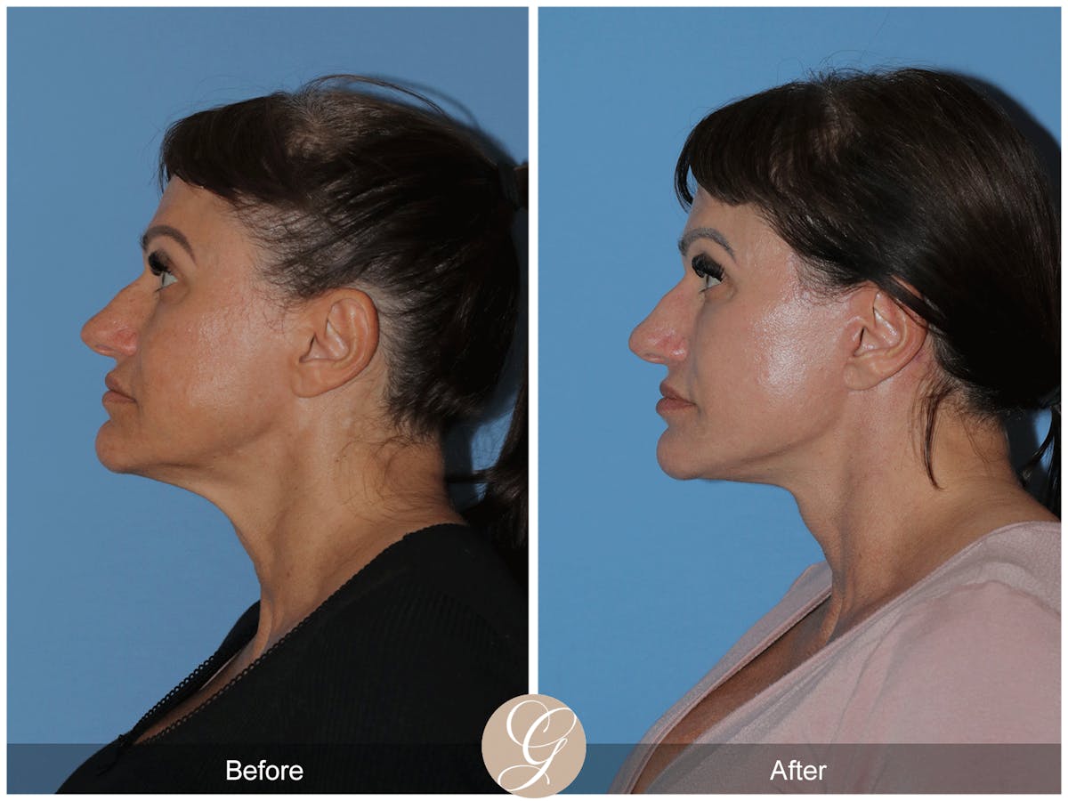 Preservation Facelift Before & After Gallery - Patient 164117 - Image 6