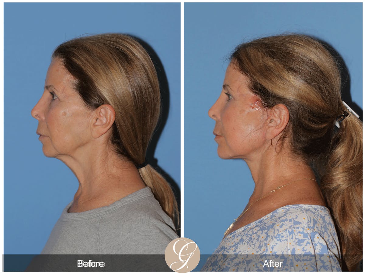Preservation Facelift Before & After Gallery - Patient 101043 - Image 8