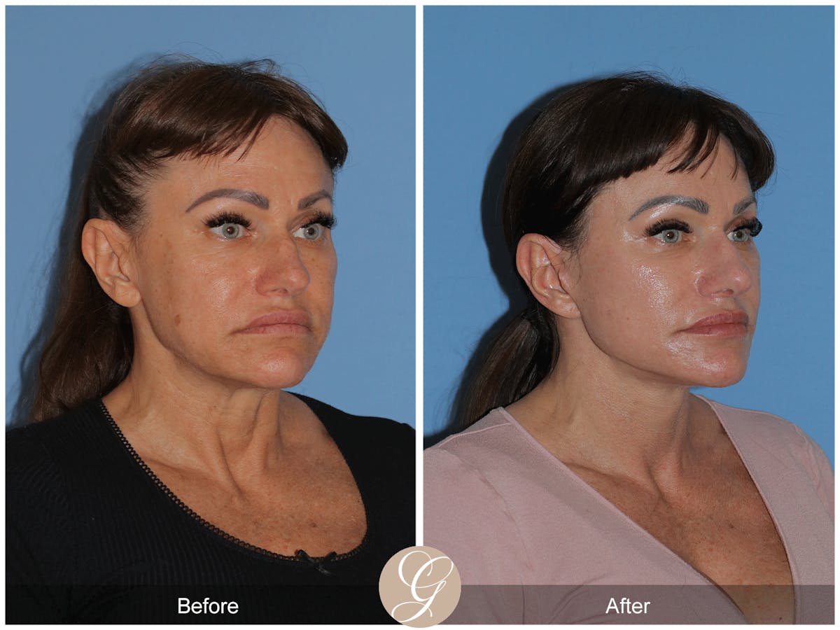 Preservation Facelift Before & After Gallery - Patient 164117 - Image 3