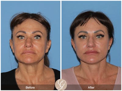 Preservation Facelift Before & After Gallery - Patient 164117 - Image 1