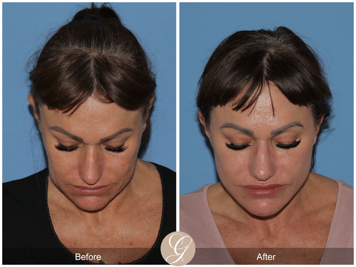 Preservation Facelift Before & After Gallery - Patient 164117 - Image 2