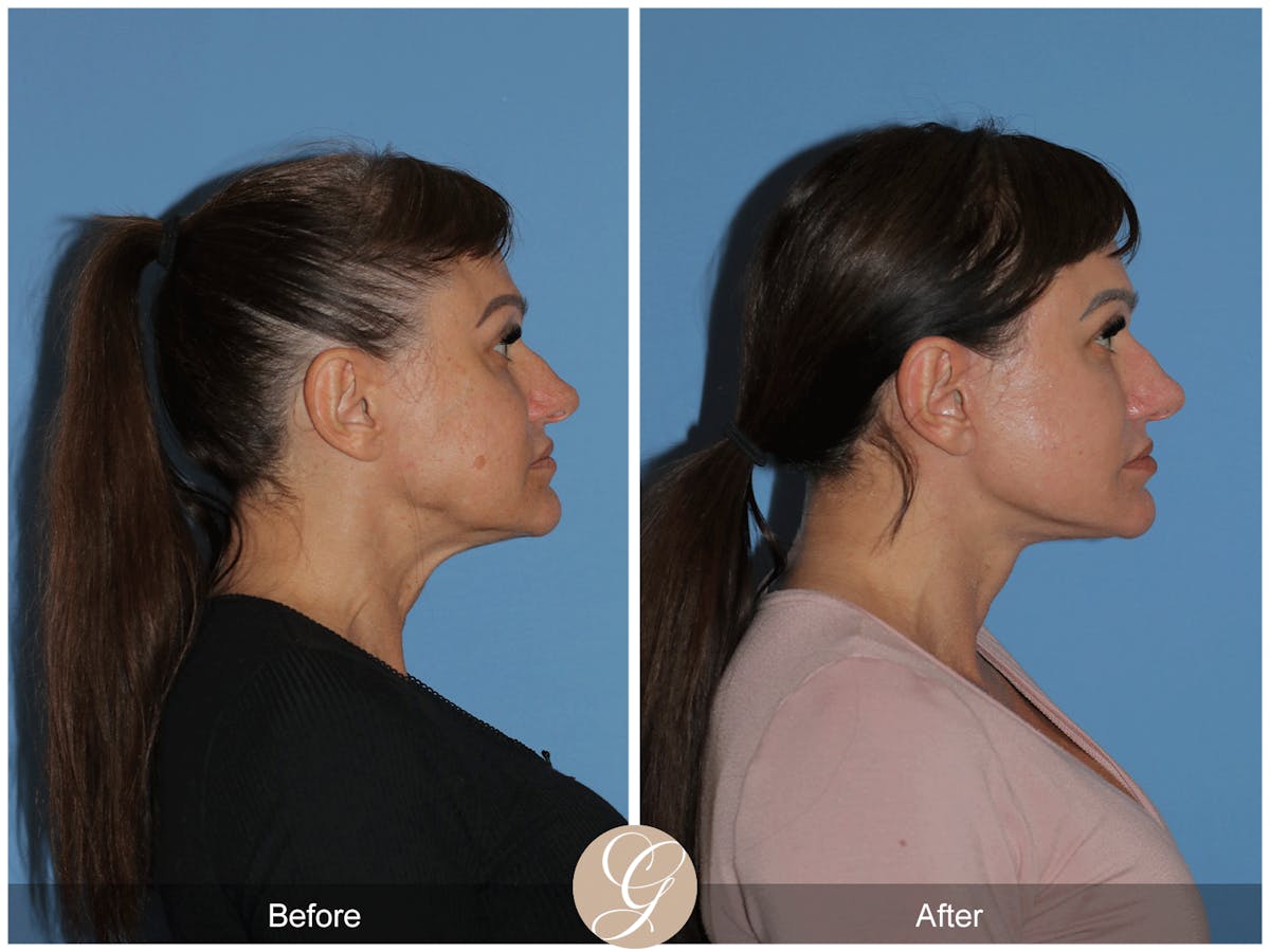 Preservation Facelift Before & After Gallery - Patient 164117 - Image 5