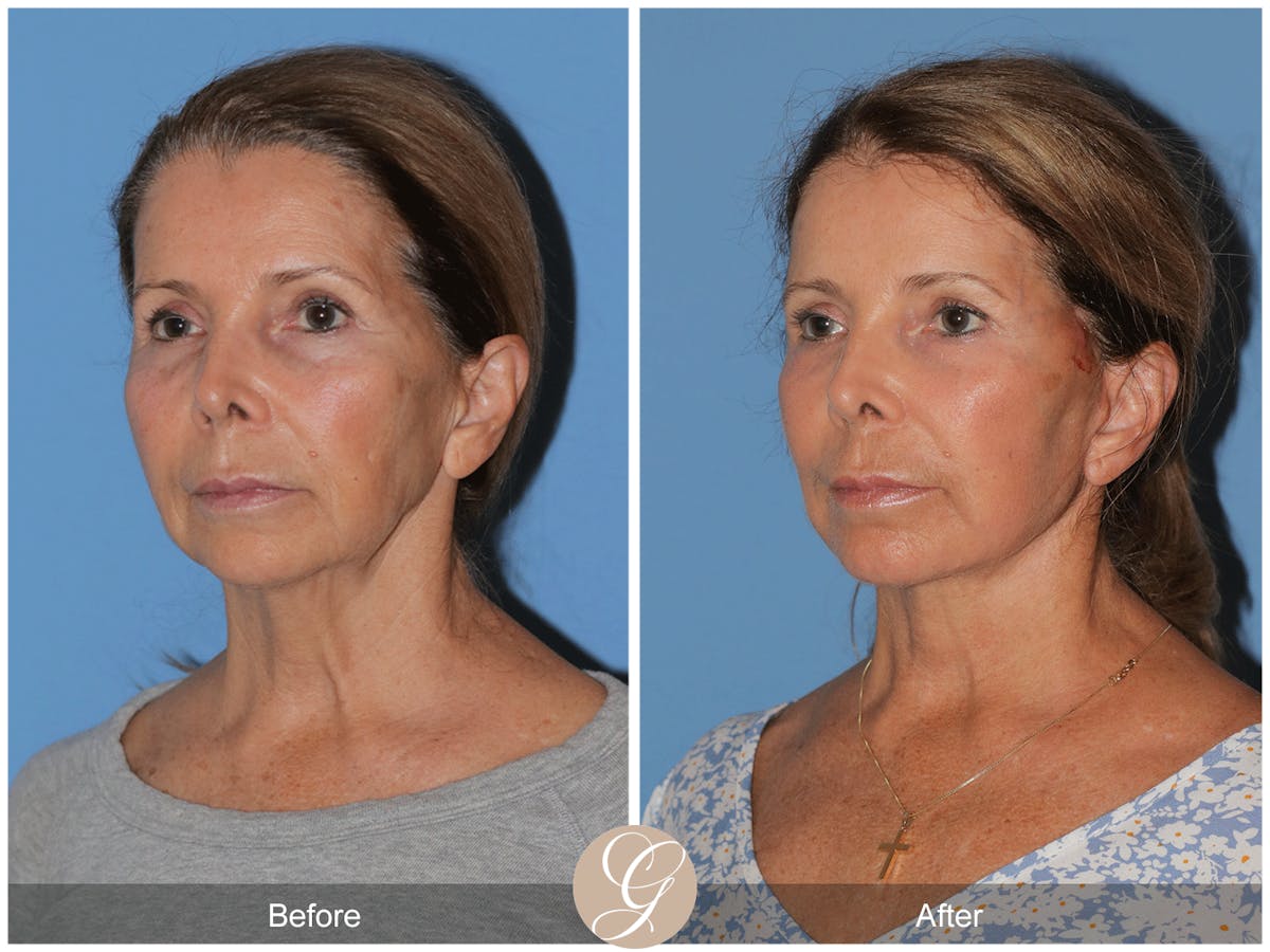 Preservation Facelift Before & After Gallery - Patient 101043 - Image 9