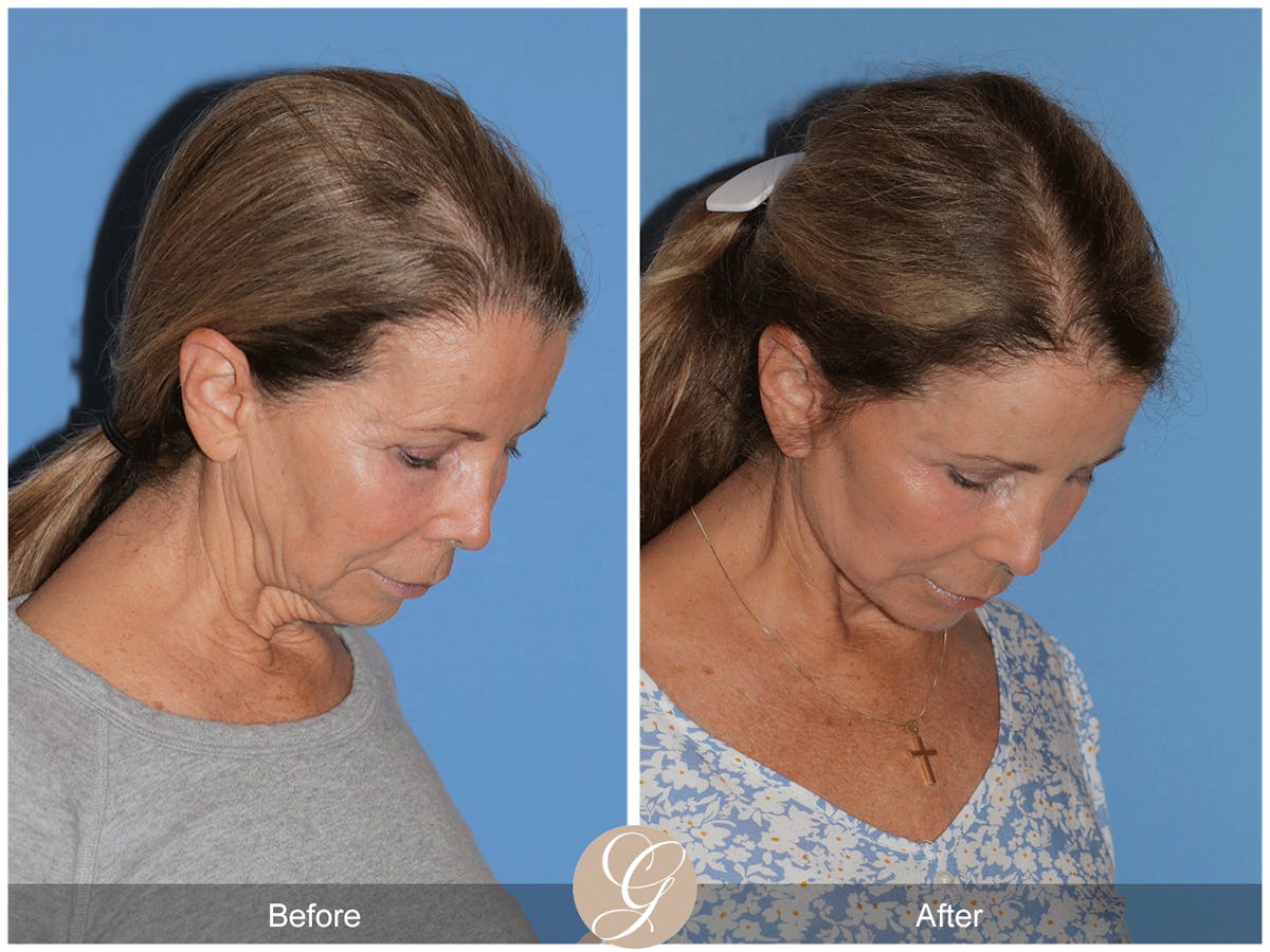 Preservation Facelift Before & After Gallery - Patient 101043 - Image 7