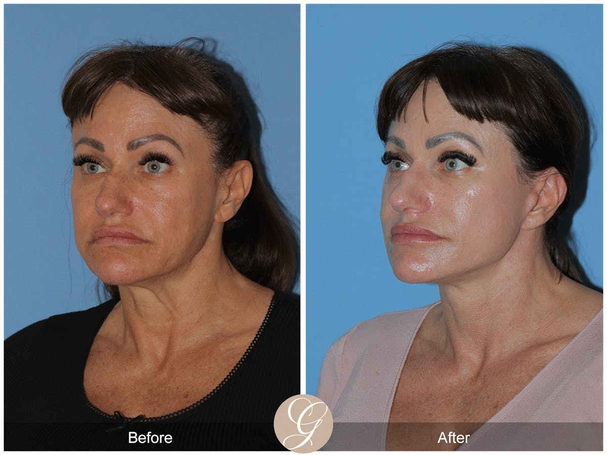 Preservation Facelift Before & After Gallery - Patient 164117 - Image 7