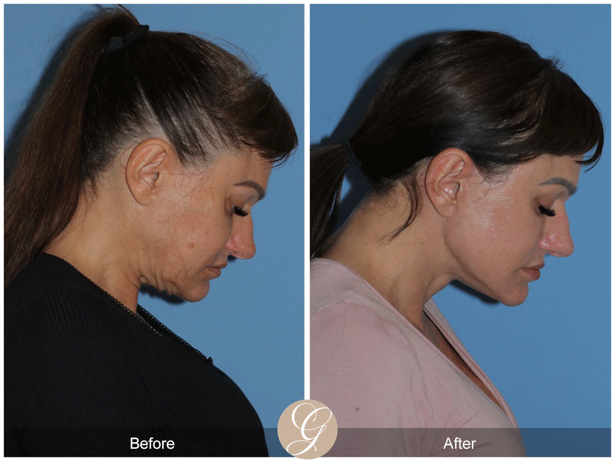 Preservation Facelift Before & After Gallery - Patient 164117 - Image 4