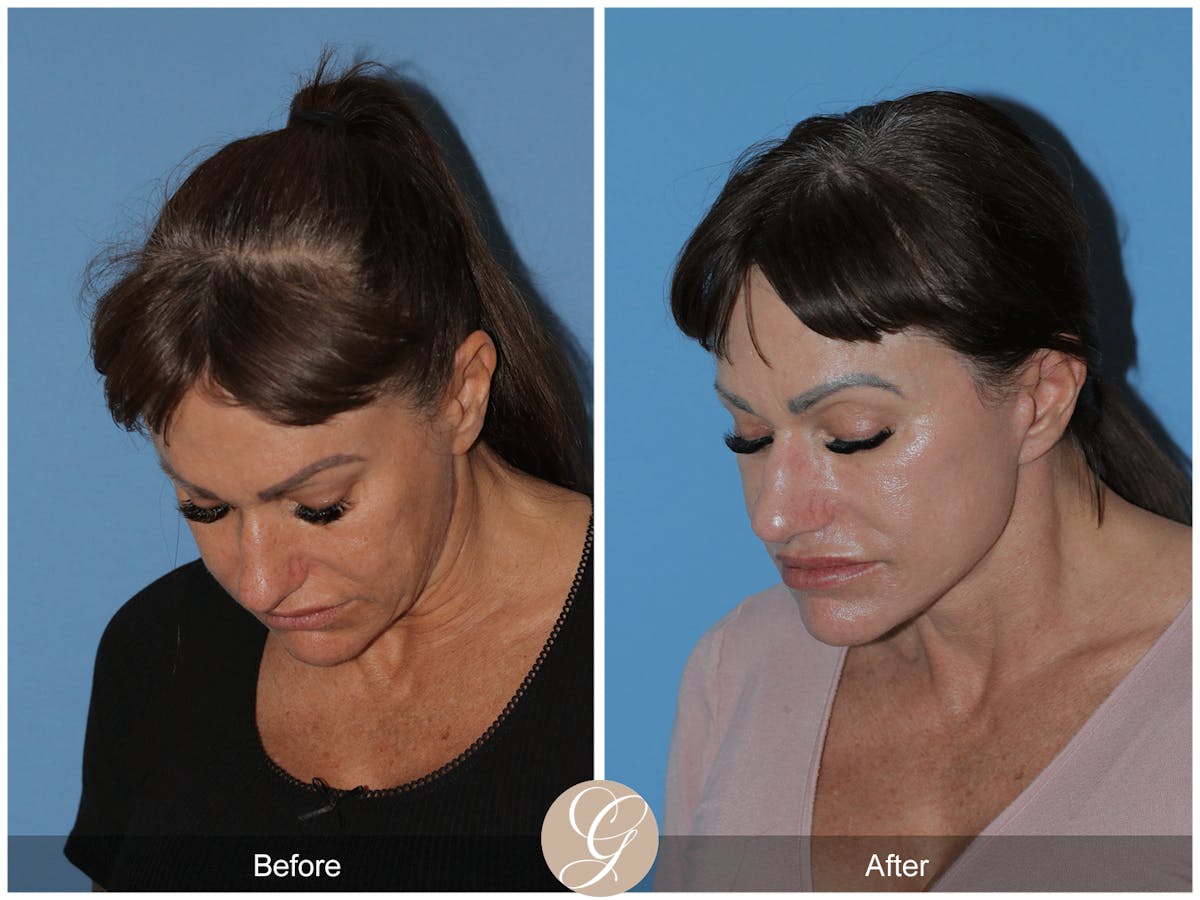 Preservation Facelift Before & After Gallery - Patient 164117 - Image 8